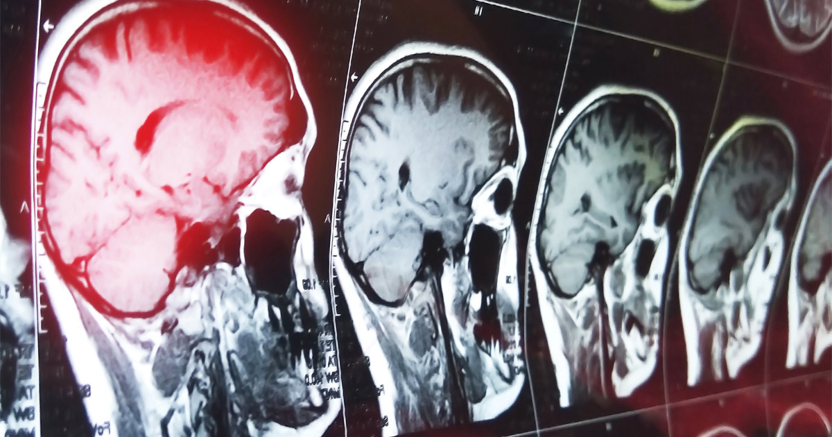 How Can I Prove a Car Accident Caused My Traumatic Brain Injury?