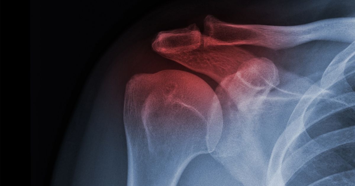 A Cincinnati Car Accident Lawyer at Wolterman Law Office Can Help You if You Have a Shoulder Injury From an Accident