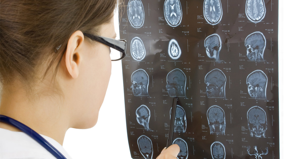 What Are the Most Common Types of Brain Injuries Caused by Truck Accidents?